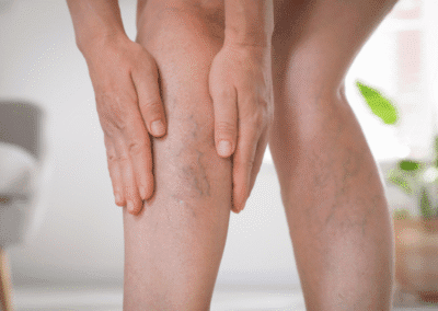 Insufficienza Venosa Napoli