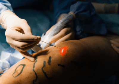 Laser Endovenoso Evlt Napoli