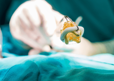 Aneurisma Aorta Napoli