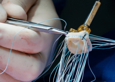 Aneurisma Aorta Napoli