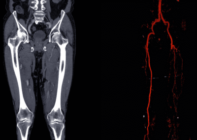 Aneurisma Aorta Napoli