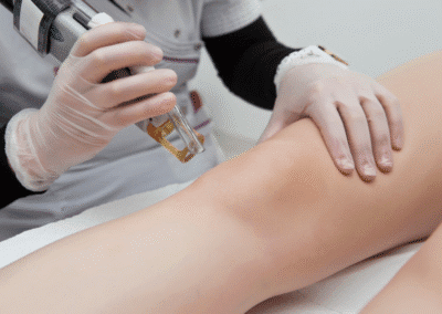 Laser Endovenoso Evlt Napoli