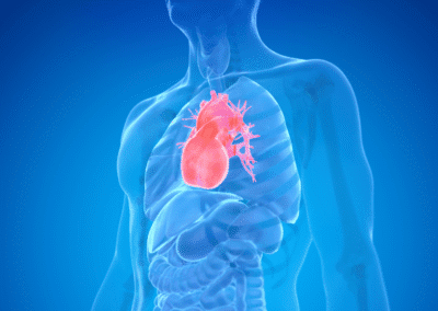 Aneurisma Aorta Napoli