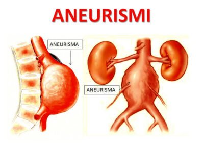 aneurisma dell'aorta napoli