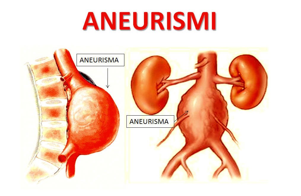 aneurisma dell'aorta napoli