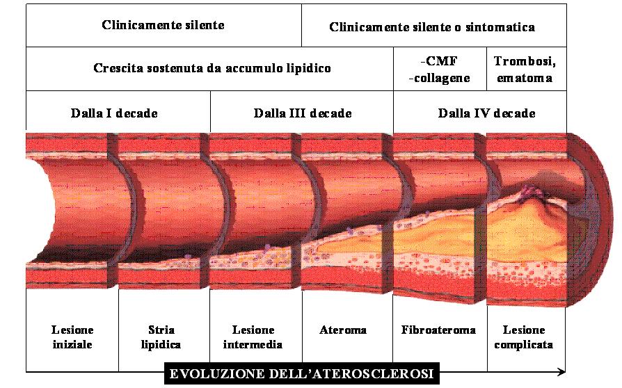 Arteriopatia Napoli